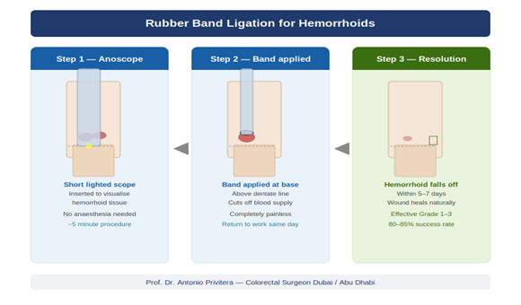 Three-step rubber band ligation procedure diagram showing anoscope insertion, band application and hemorrhoid resolution