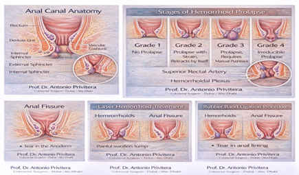 Prof Dr Antonio Privitera THD laser and rubber band ligation procedures illustrated for Dubai patients