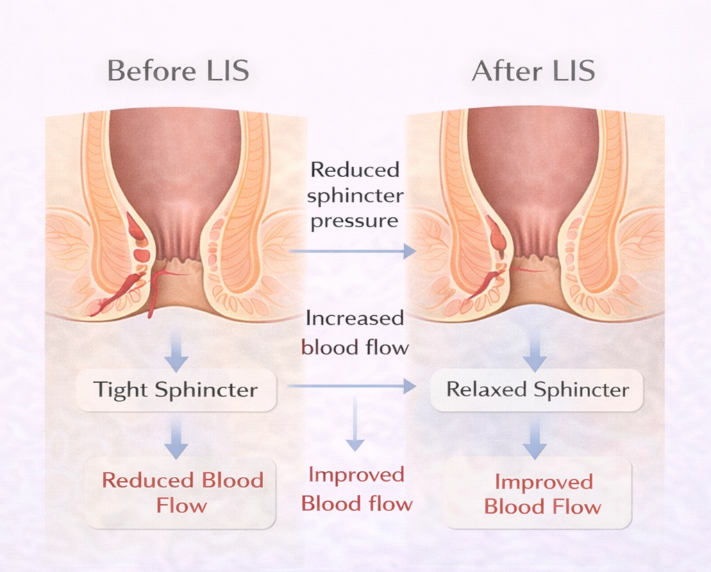 Diagram showing how lateral internal sphincterotomy reduces pressure, improves blood flow, and allows anal fissure healing
