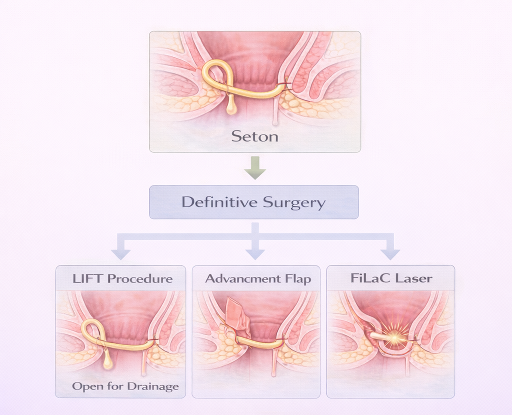 Flowchart showing anal fistula treatment pathway starting with seton placement followed by definitive surgical options