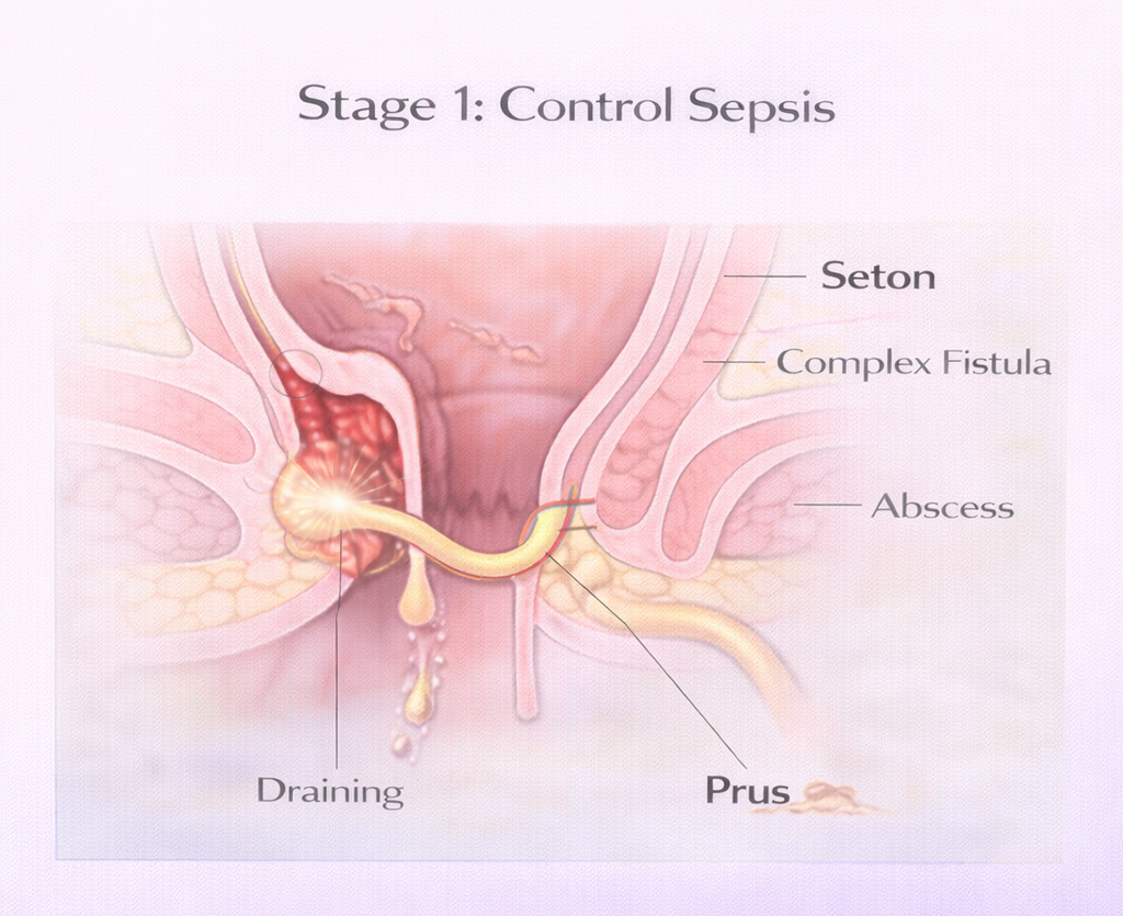 Diagram showing seton placement in complex anal fistula to control infection and allow drainage before definitive treatment