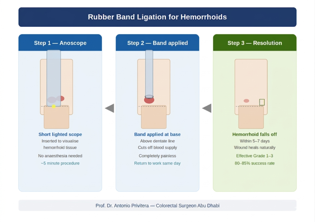 Step-by-step minimally invasive hemorrhoid procedure showing office treatment without anaesthesia